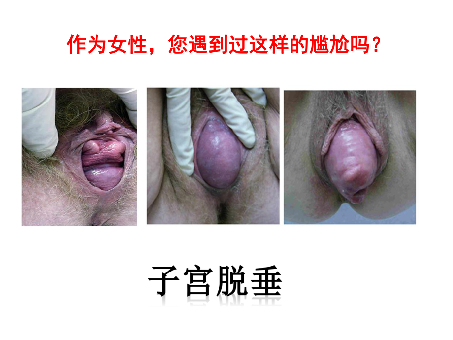 女性盆底功能障碍性疾病课件.ppt_第3页