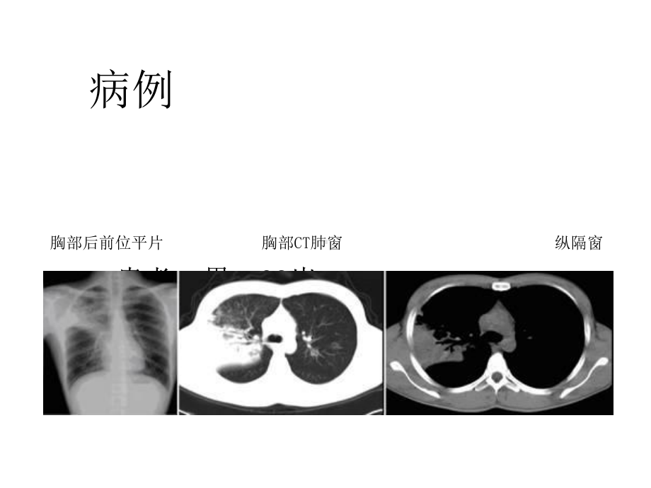 大叶性肺炎的影像诊断版本课件.ppt_第3页