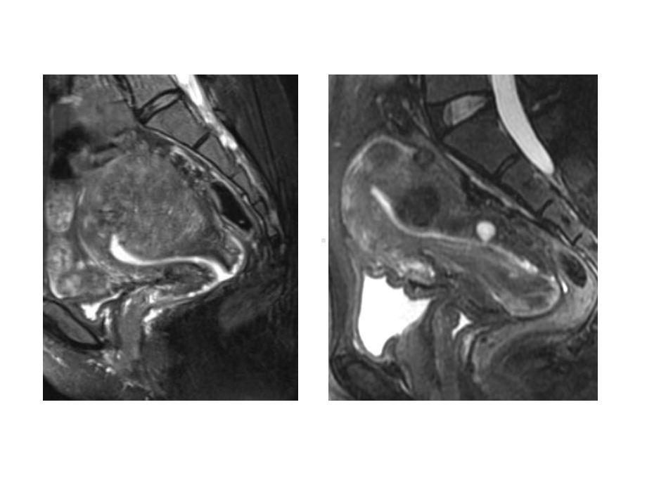 子宫腺肌症的MRI诊断课件.ppt_第1页