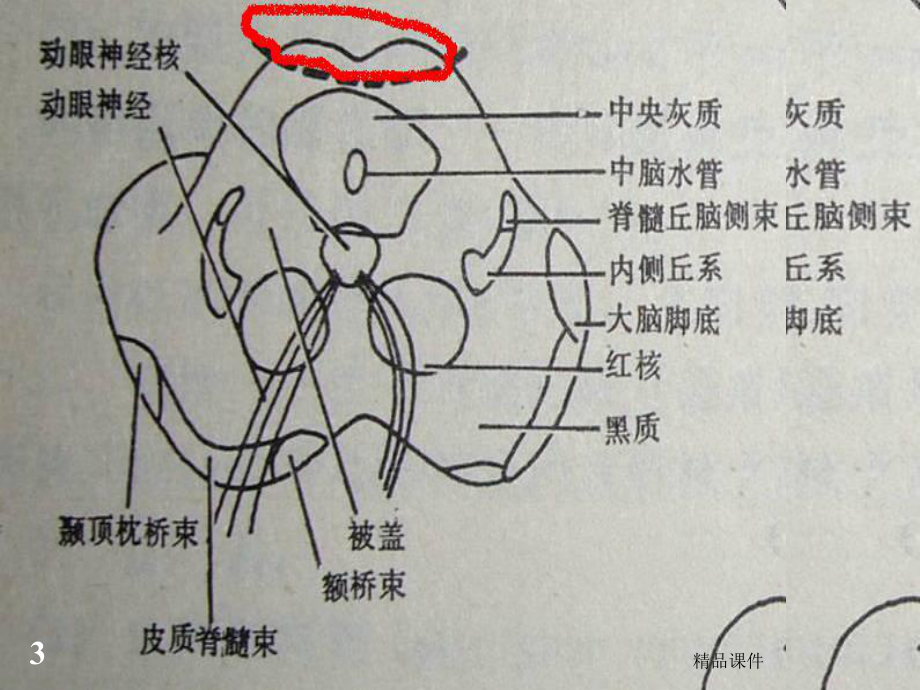 常见的脑干损害综合征医学课件.ppt_第3页