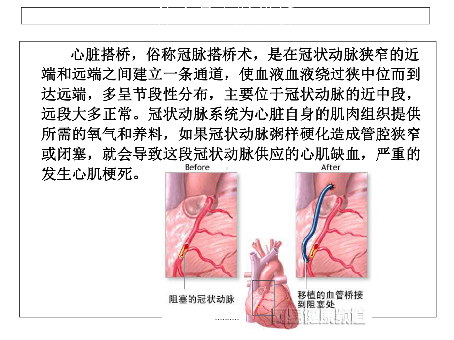 搭桥术后护理查房（通用）课件.ppt_第2页