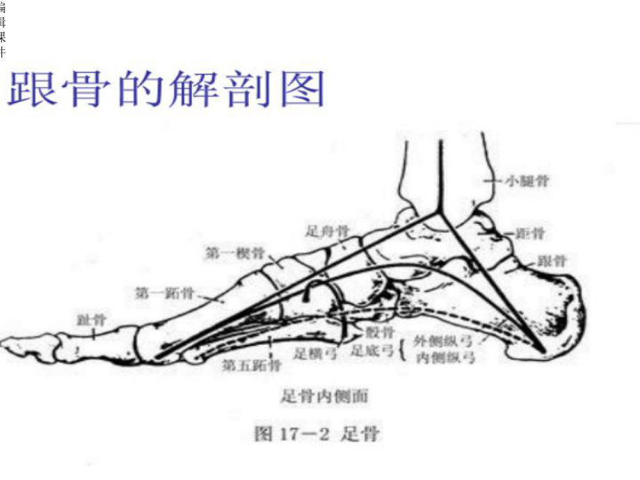 新建跟骨骨折的护理查房课件.ppt_第3页