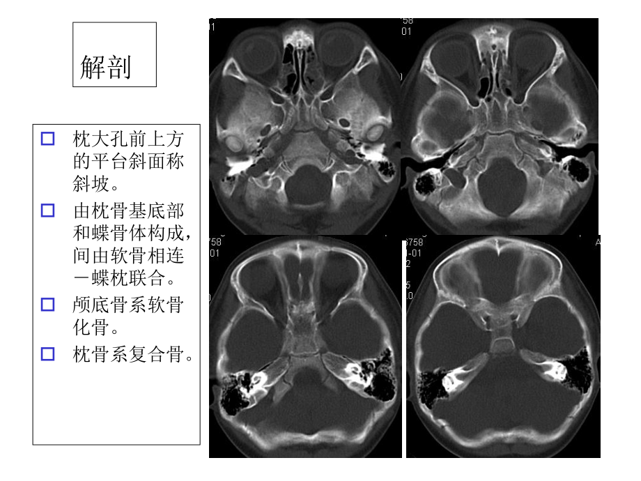 斜坡病变的影像诊断课件.ppt_第2页