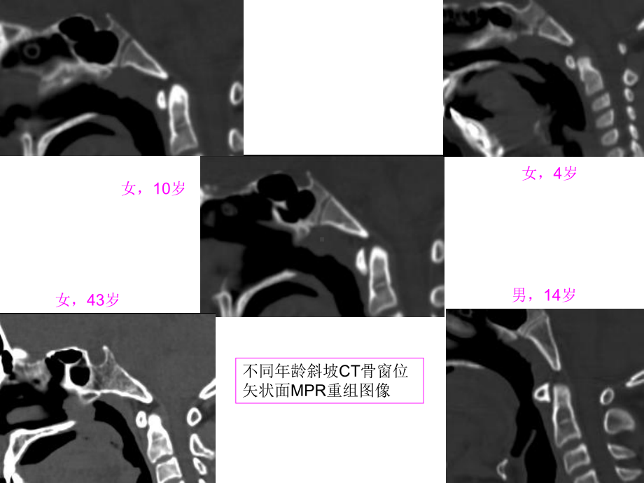 斜坡病变的影像诊断课件.ppt_第3页