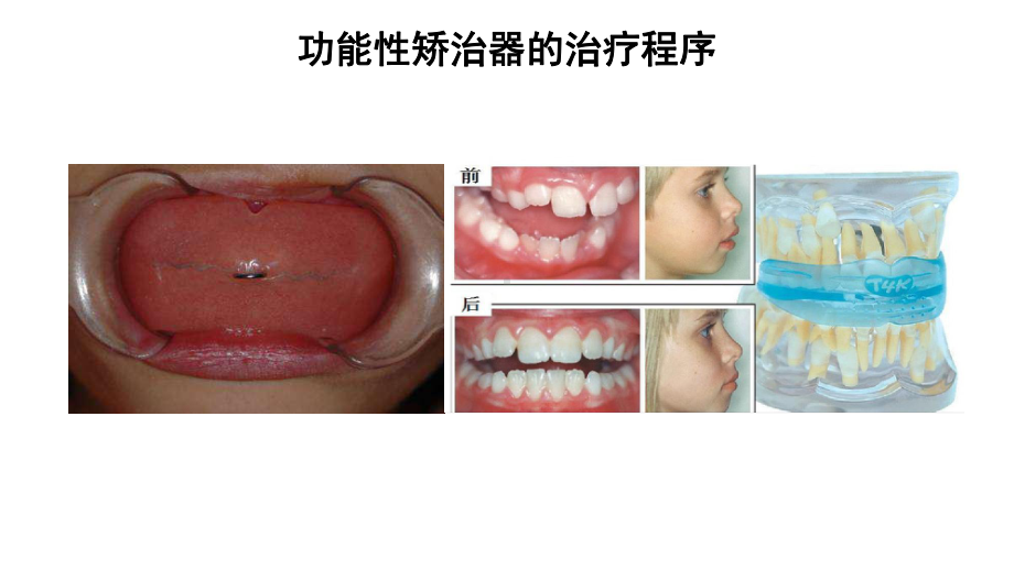 口腔正畸学：功能性矫治器的治疗程序课件.pptx_第3页