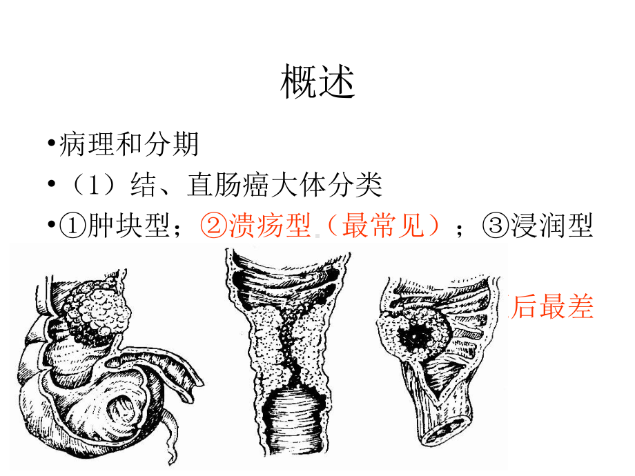 大肠癌病人的护理课件.pptx_第3页