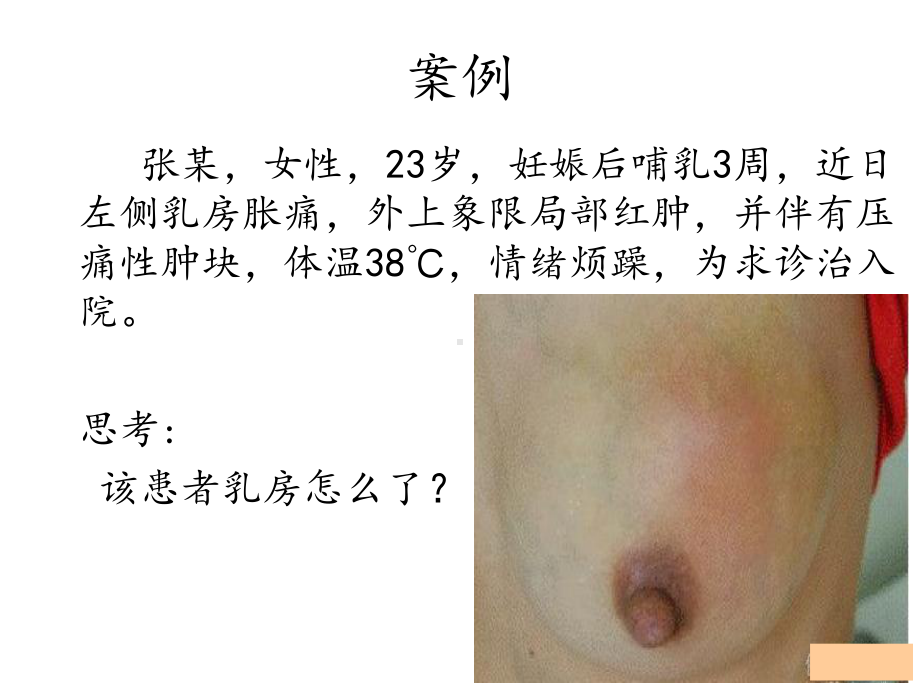 急性乳腺炎完整版课件.pptx_第2页