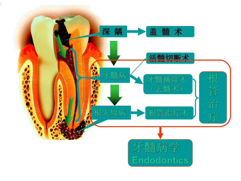 根管治疗的步骤方法器械4课件.ppt_第2页