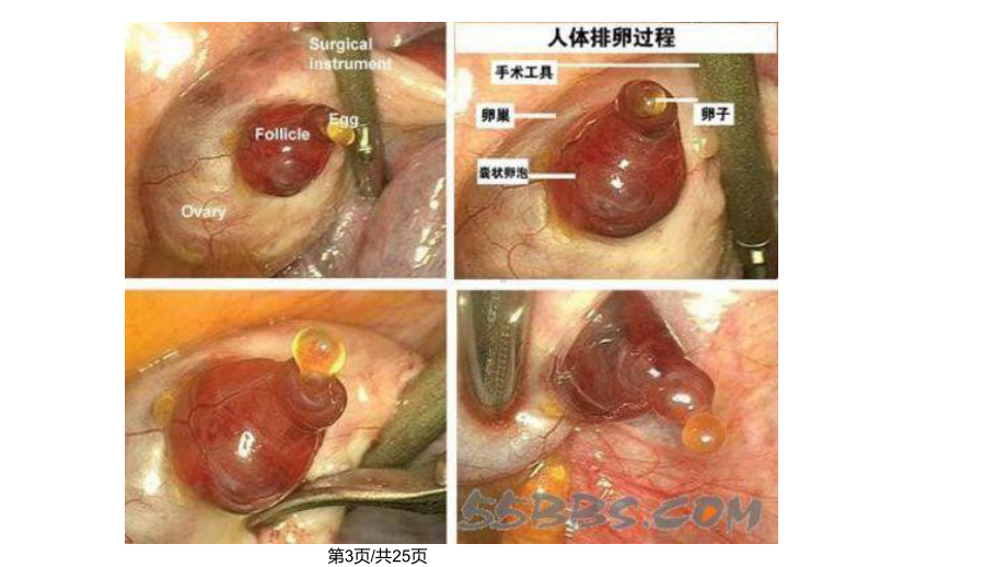 卵巢黄体破裂课件.pptx_第3页