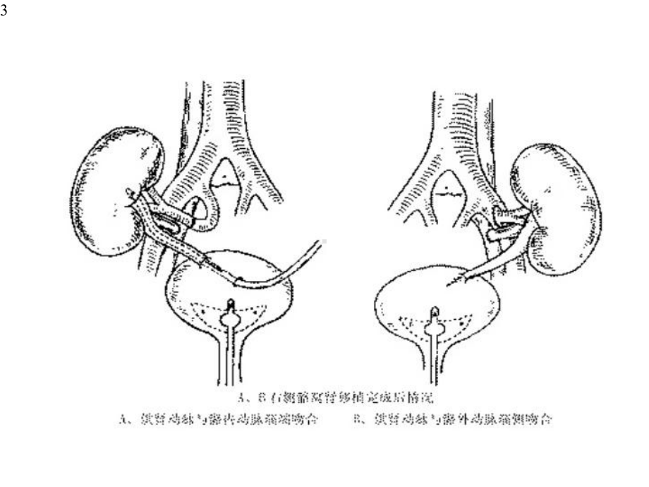 器官移植病人的麻醉课件.pptx_第3页