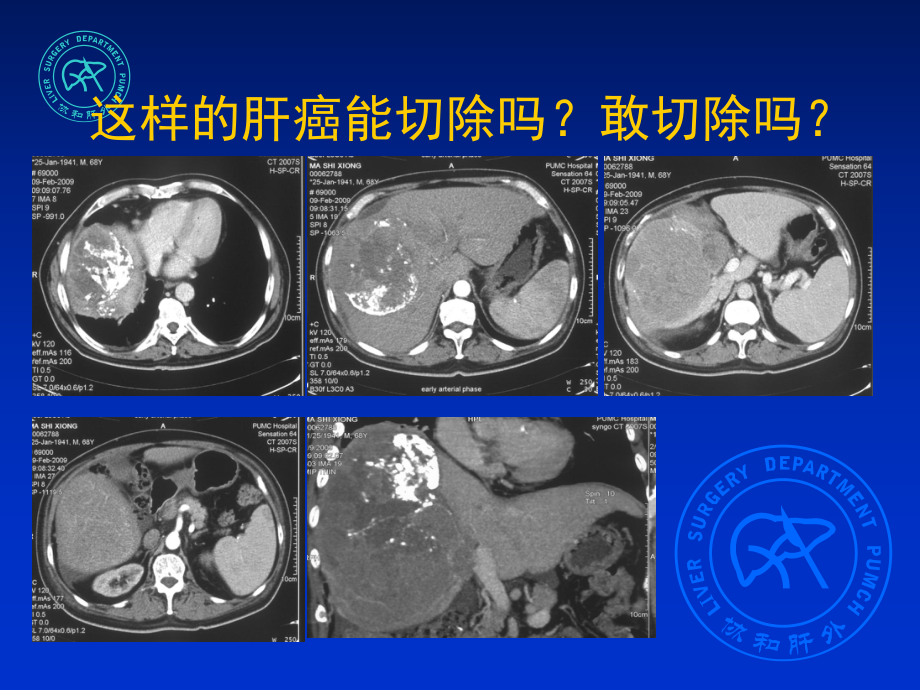 三维立体肝功能检测在肝脏术前评估中的应用课件.ppt_第2页