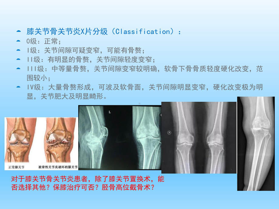 保膝治疗之1-胫骨高位截骨术课件.ppt_第2页