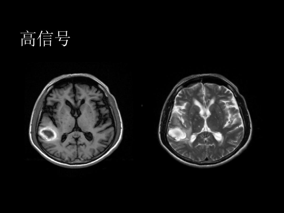 中枢神经系统疾病MRI基本阅片的技能123张课件.ppt_第3页