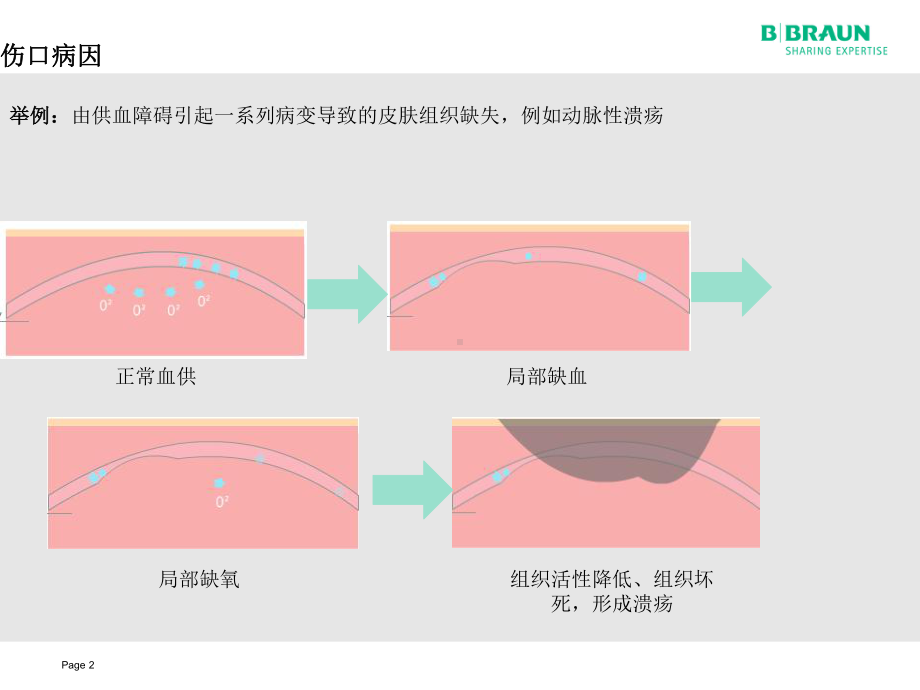 伤口及伤口治疗的生理病理知识课件.ppt_第2页