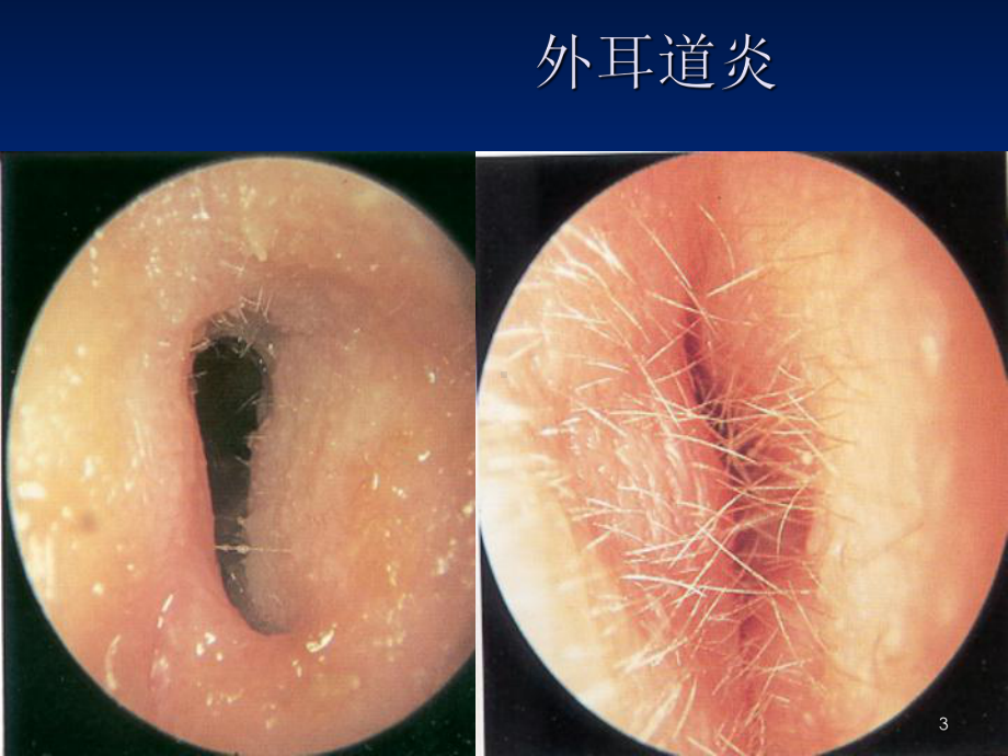 五官科护理第六章(耳部)常见疾病病人的护理课件.ppt_第3页