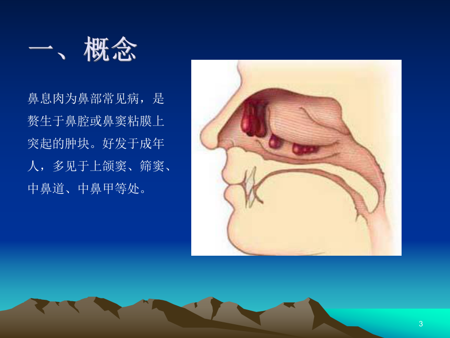 五官科鼻息肉课件.ppt_第3页