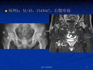 中青年髋关节疼痛的影像鉴别诊断课件.ppt