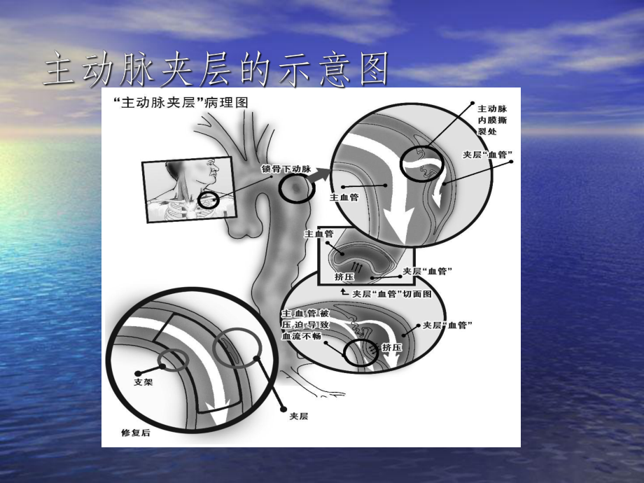 主动脉夹层急诊诊断课件.ppt_第3页