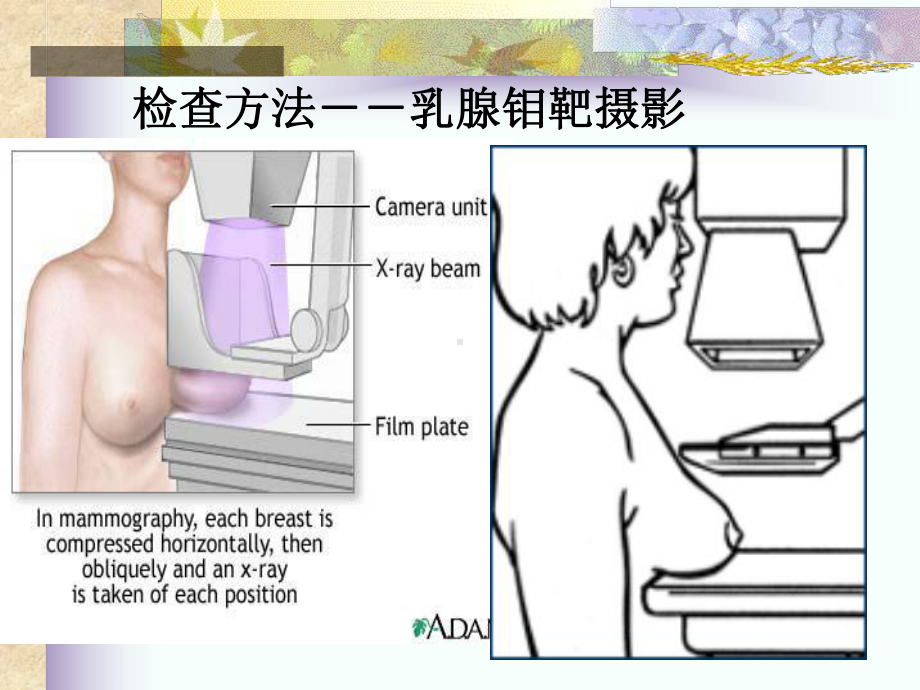 乳腺钙化的X线鉴别诊断课件.ppt_第3页