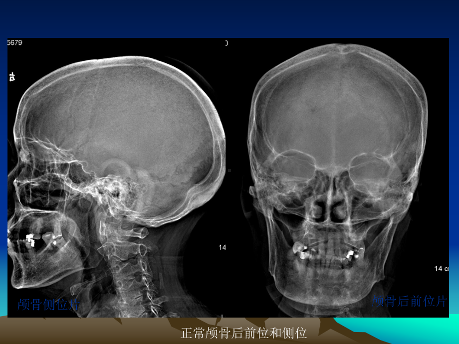 中枢神经系统影像学表现课件.ppt_第3页