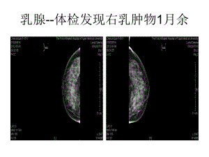 临床乳腺病例课件.ppt