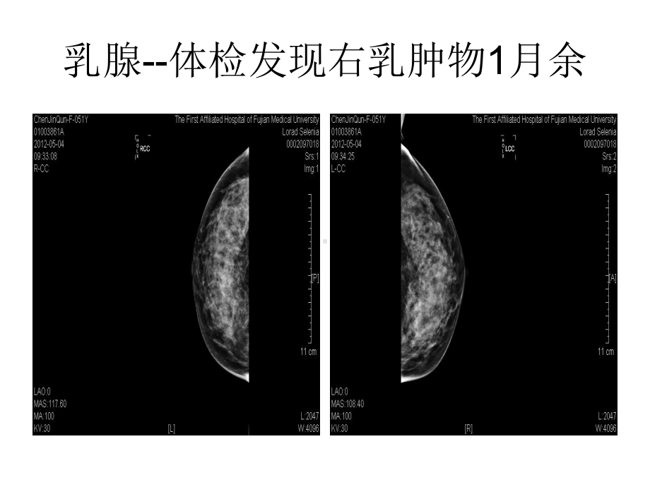 临床乳腺病例课件.ppt_第1页