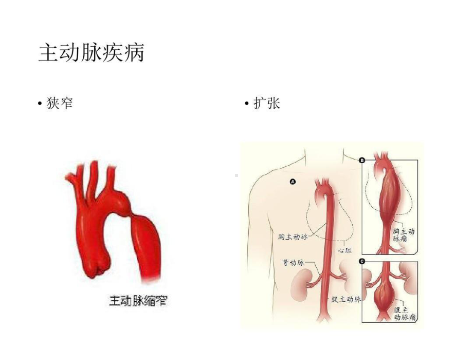 主动脉疾病的微创治疗共66张课件.ppt_第3页