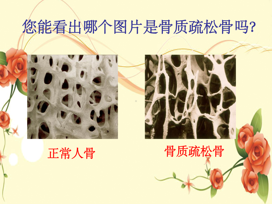 专科护理学习骨质疏松课件.ppt_第3页