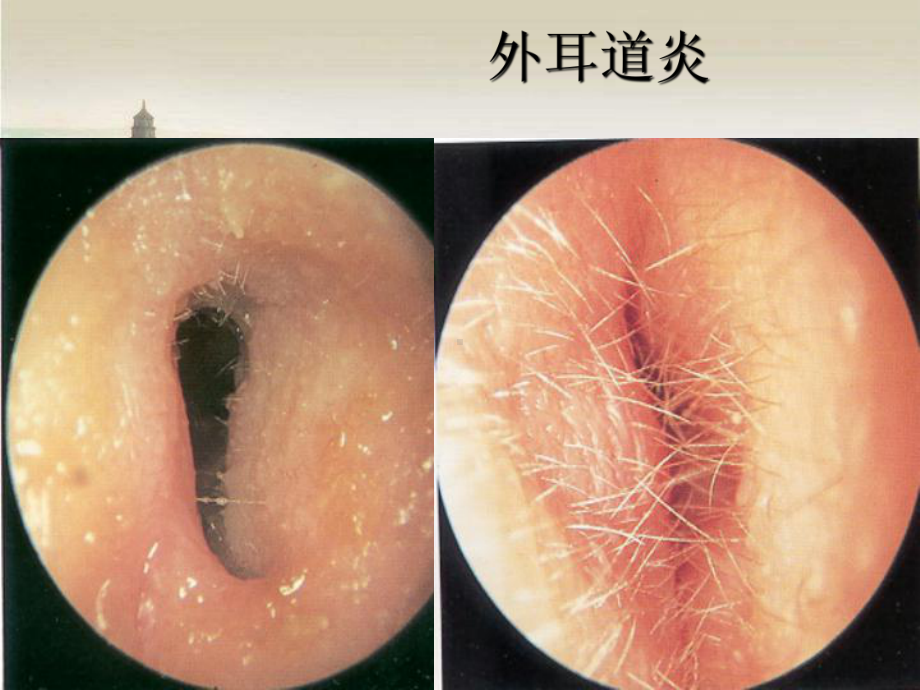 五官科护理-第六章(耳部)常见疾病病人的护理-课件.ppt_第3页