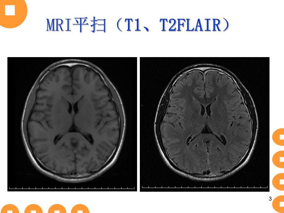 低颅压综合征正稿课件.ppt_第3页