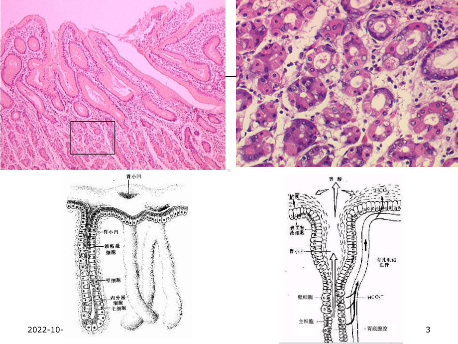 临床医学病理学课堂病理消化系统疾病课件.ppt_第3页