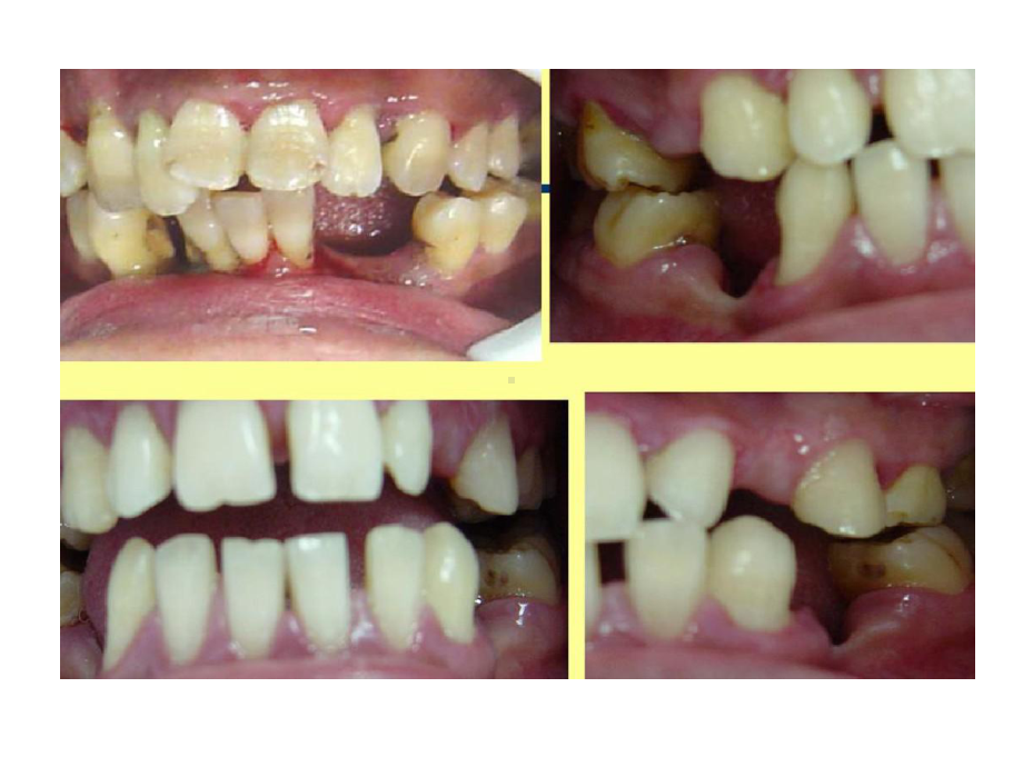 侵袭性牙周炎-反映全身疾病牙周炎共18张课件.ppt_第3页