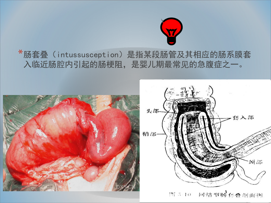 小儿急性肠套叠课件.ppt_第3页