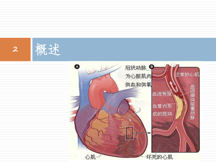 急性心肌梗死的临床生化指标及检测方法课件.ppt_第2页