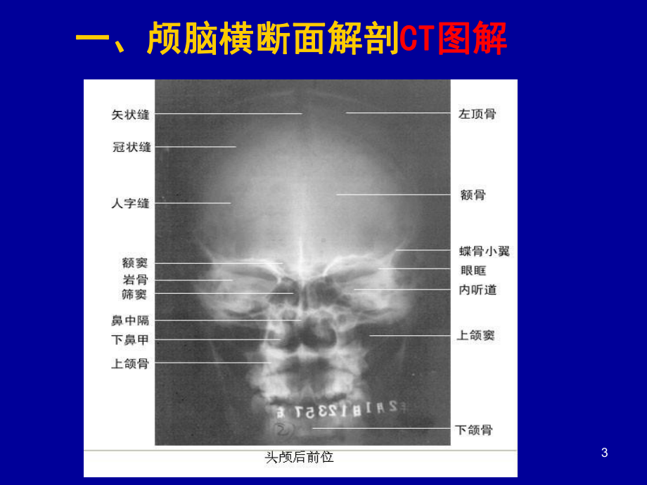 头颈部CT应用课件课件.ppt_第3页