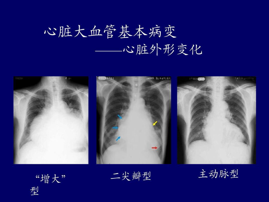 心血管疾病影像学诊断共64张课件.ppt_第3页