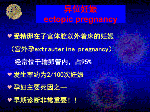 异位妊娠ectopicpregnancy课件.ppt