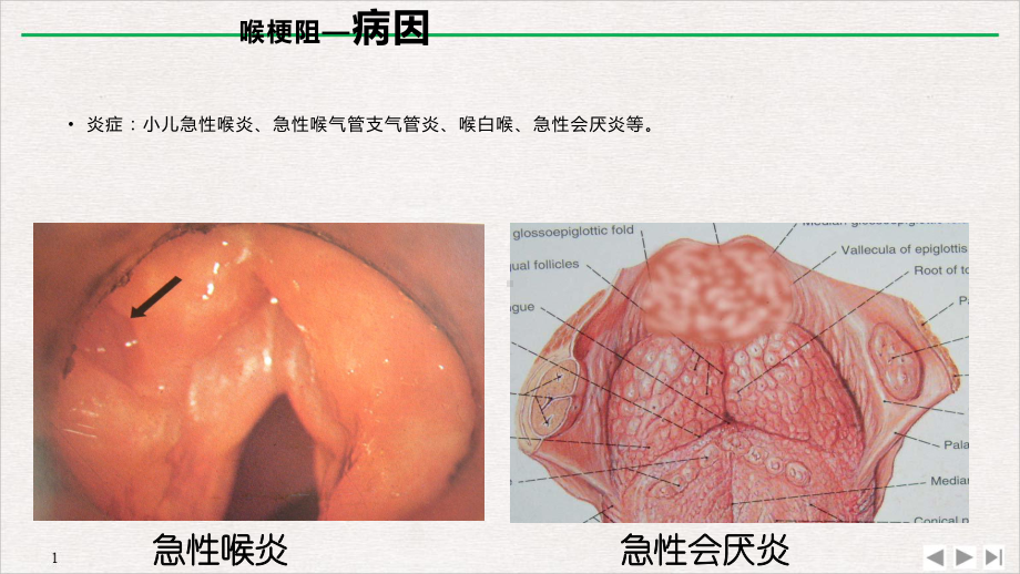 喉梗阻教学课件.pptx_第3页