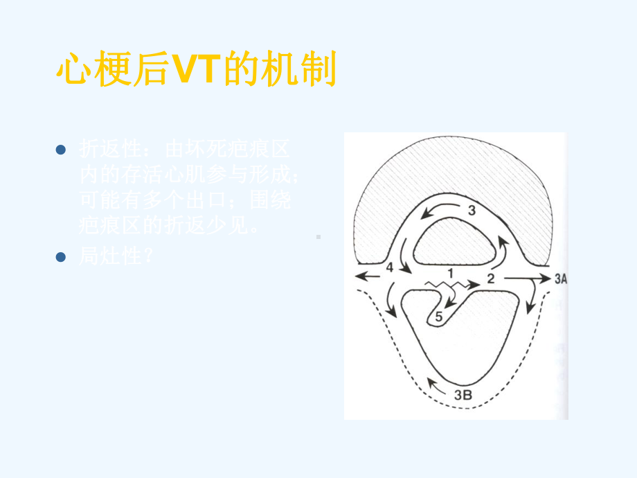 室性心动过速的电生理特点与射频消融治疗课件.ppt_第2页