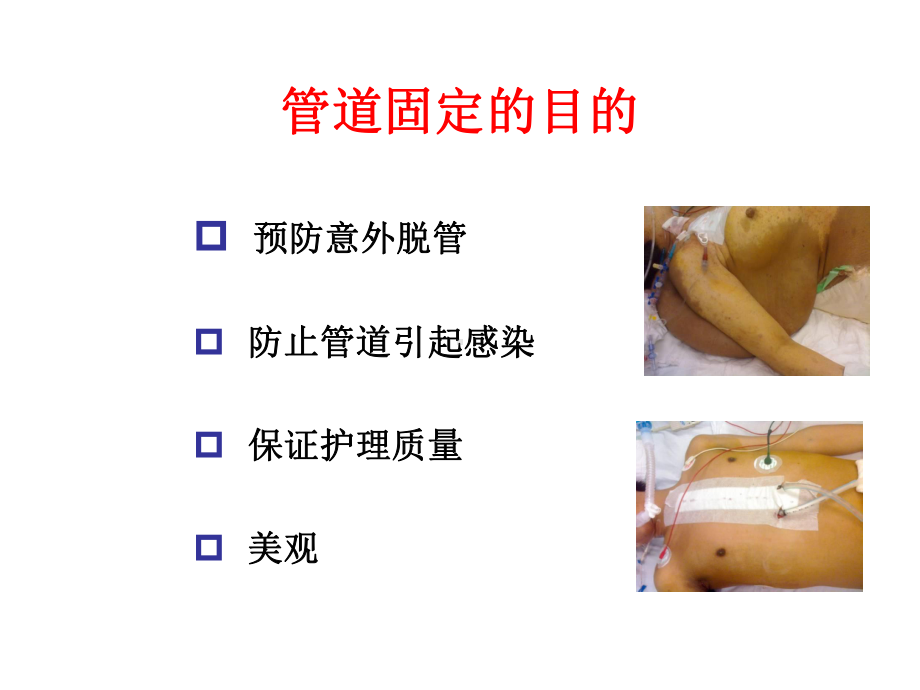 危重病人管道安全固定(32张)课件.ppt_第3页