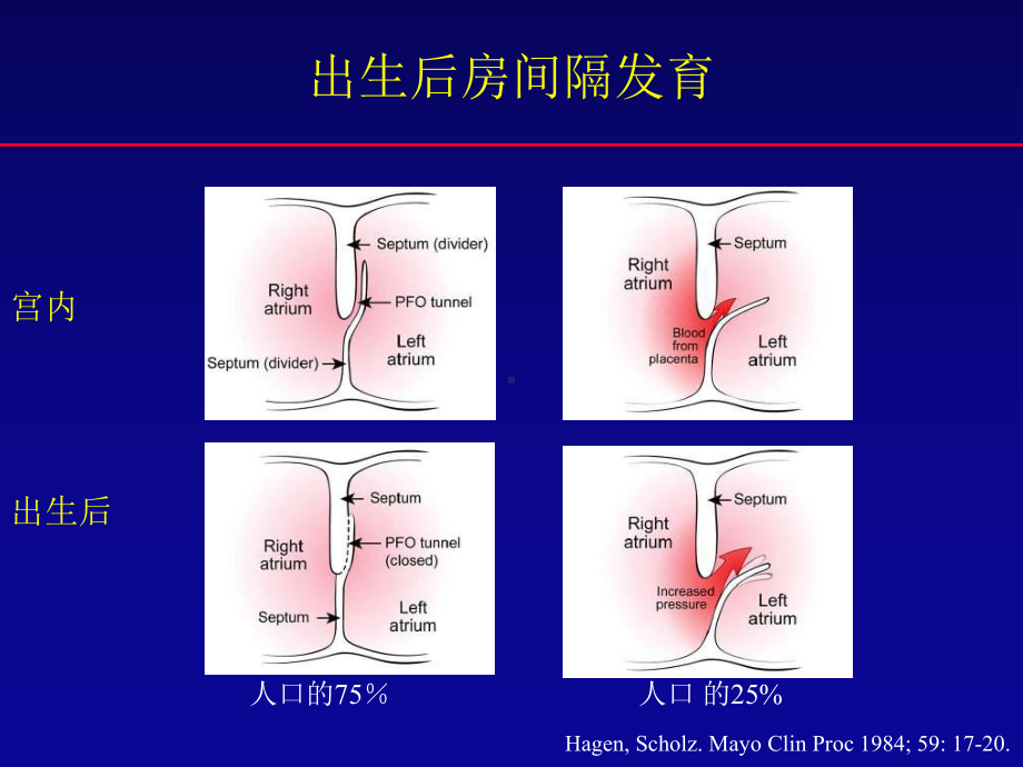 卵圆孔未闭封堵术：争论与发展(中英文)课件.ppt_第3页