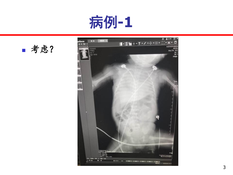 危重症患儿的识别课件.ppt_第3页