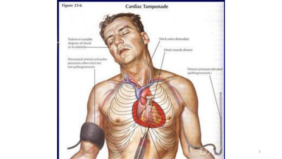 心包穿刺术教学参考课件.ppt_第3页