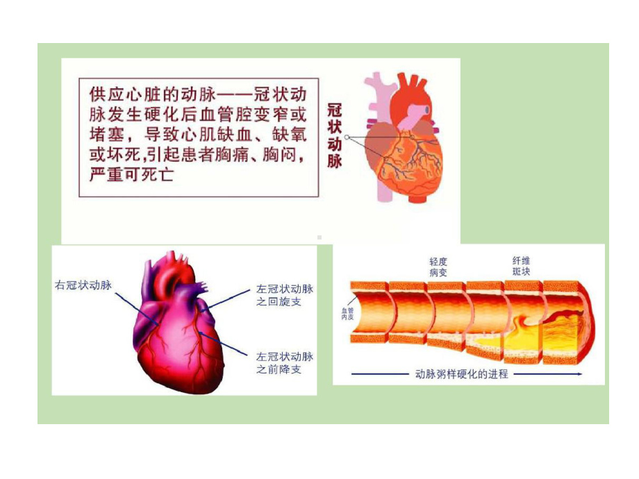 冠心病诊断与治疗讲解共30张课件.ppt_第3页