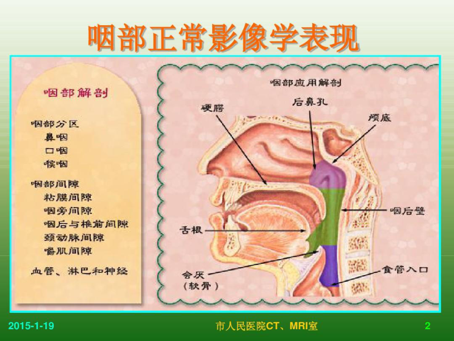 儿童腺样体肥大影像表现及诊断标准共76张课件.ppt_第2页