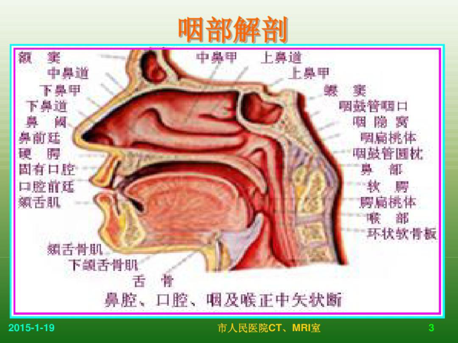 儿童腺样体肥大影像表现及诊断标准共76张课件.ppt_第3页