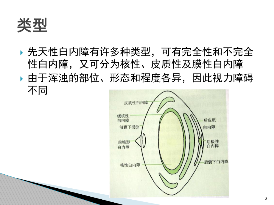 先天性白内障课件.ppt_第3页