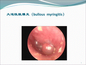 大泡性鼓膜炎(bullousmyringitis)课件.ppt