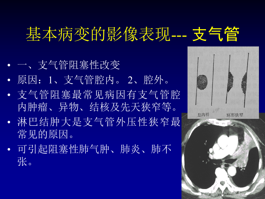 呼吸系统基本病变3课件.ppt_第3页