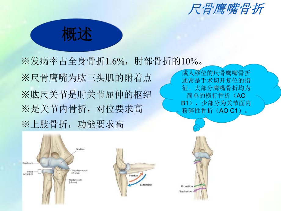 尺骨鹰嘴骨折-课件-2.ppt_第3页